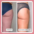 Complex gegen Cellulite und Fett + Bürste als Geschenk dazu