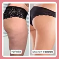 Complex gegen Cellulite und Fett + Bürste als Geschenk dazu